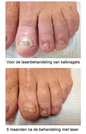 Voor en na de laserbehandeling van de kalknagels Voor de laserbehandeling van de kalknagels