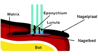 Het laseren van de kalknagel